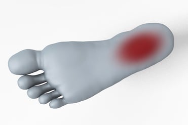 Plantar Fasciitis