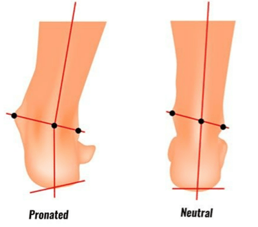 Pronation due to tight-fitting boots-1